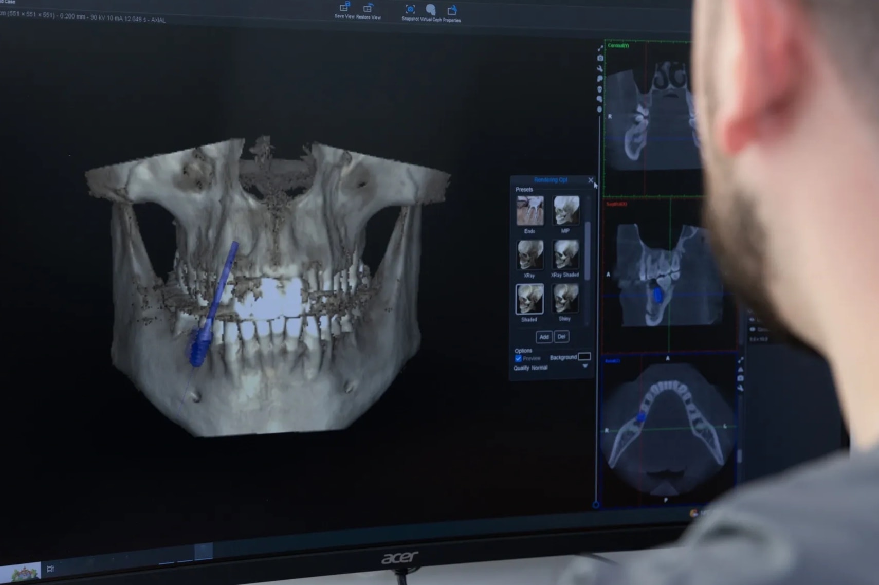 3D dental imaging software showing jaw CT scan on monitor