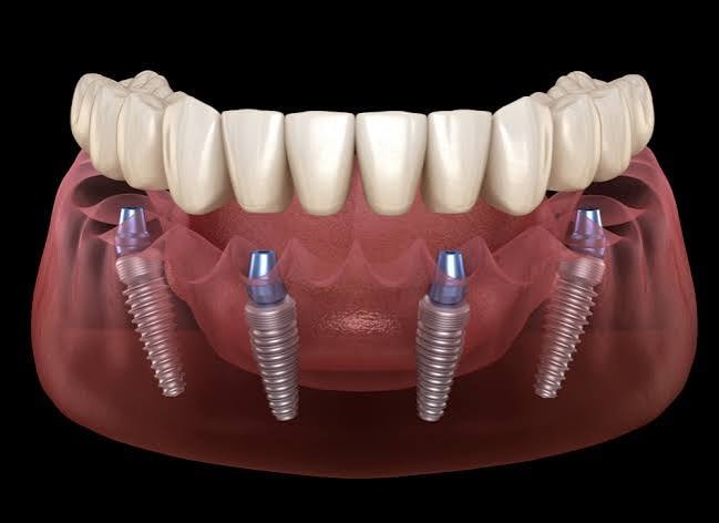 Dental implant prosthetic restoration